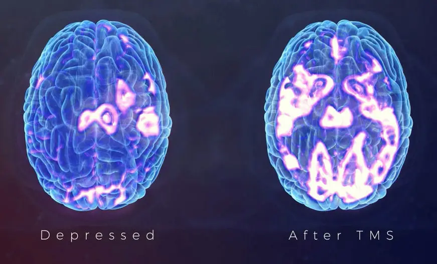 transcranial magnetic stimulation treatment centers transcranial magnetic stimulation treatment