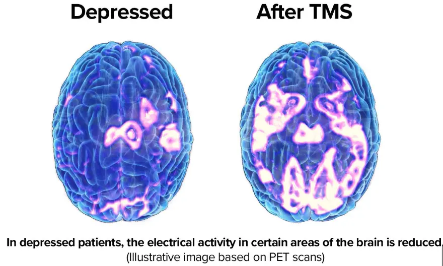 transcranial magnetic stimulation treatment centers transcranial magnetic stimulation treatment