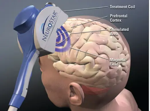transcranial magnetic stimulation treatment centers transcranial magnetic stimulation treatment